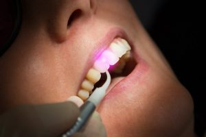 close-up of laser dentistry in Arcadia 