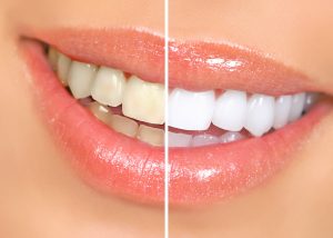 smile teeth whitening