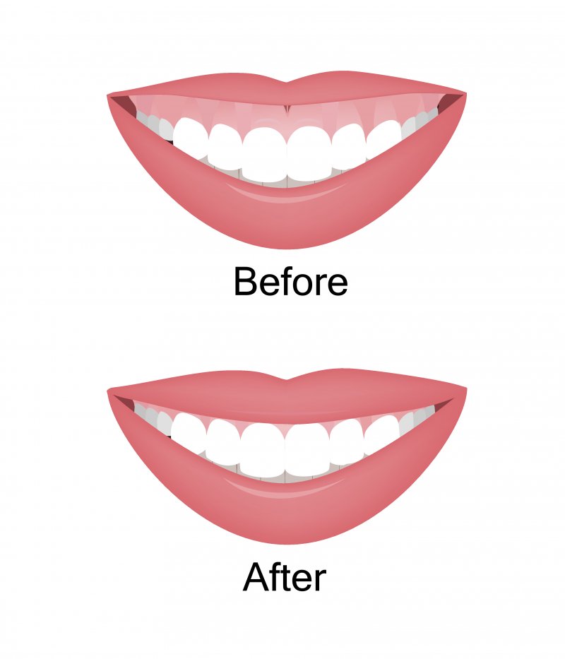 Illustration of gummy smile before and after treatment