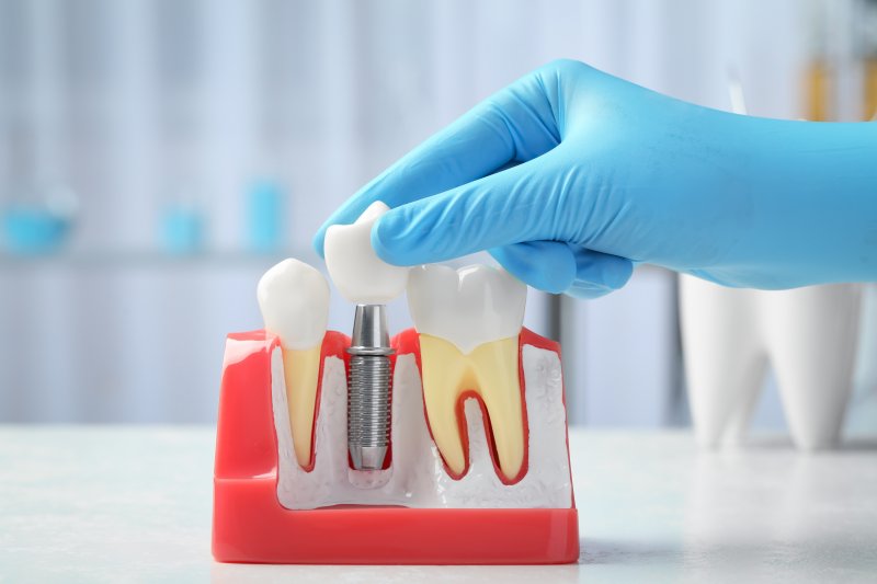 Dentist placing a fake crown on a model of teeth