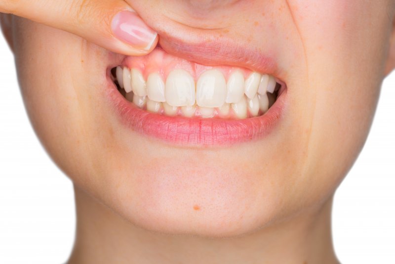 Woman smiling after gum recontouring