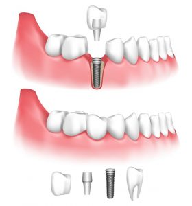 Dental implants in Arcadia replace missing teeth and preserve the jaw. Find out if you are a candidate for these innovative prosthetics from Kenneth Canzoneri DDS.