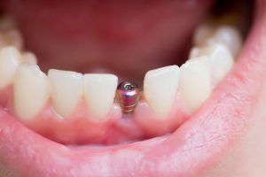 mouth open dental implant post 