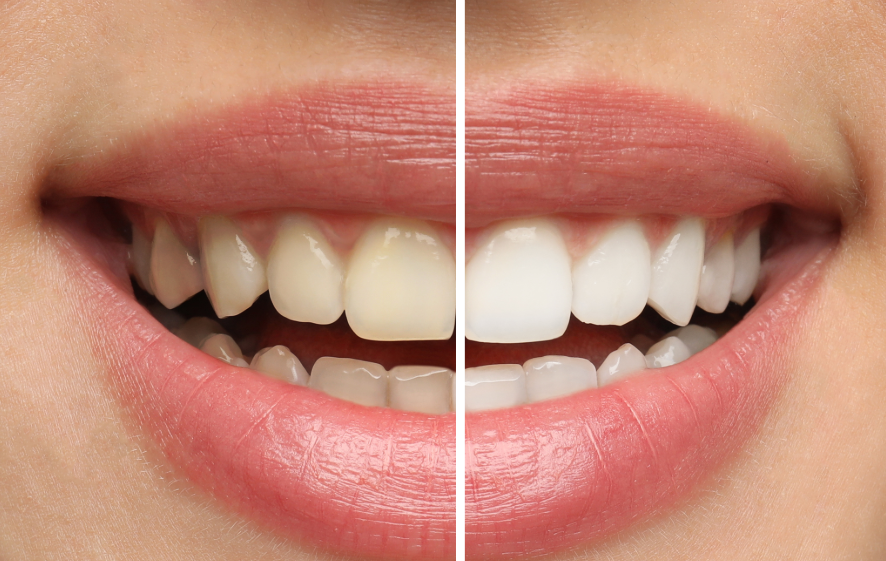 Close up of woman's smile half yellow, half white teeth (before and after style)