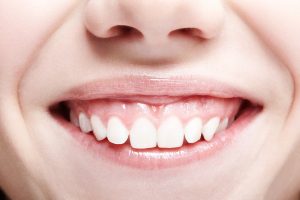 Close up of woman's smile with lots of gums