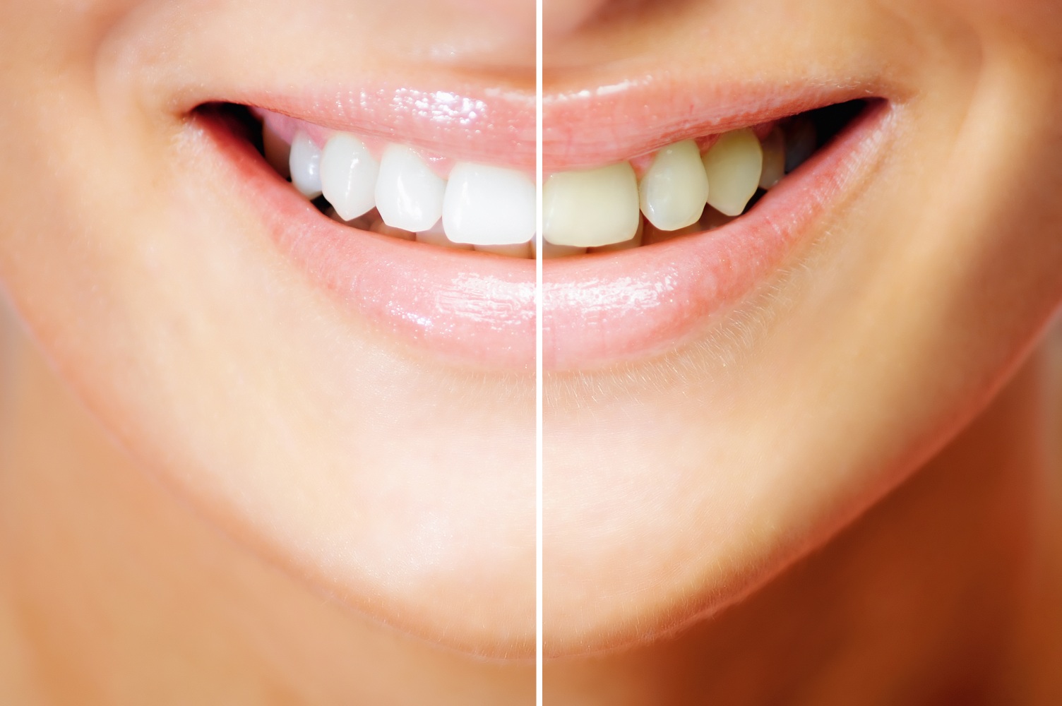 What’s the Difference Between InOffice and AtHome Teeth Whitening? Dr. J. Canzoneri